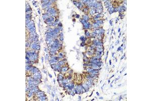 Immunohistochemistry of paraffin-embedded human colon carcinoma using RALB antibody (ABIN6293713) at dilution of 1:100 (40x lens). (RALB anticorps)