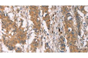 Immunohistochemistry of paraffin-embedded Human gastric cancer using PLIN2 Polyclonal Antibody at dilution of 1:30 (ADRP anticorps)