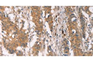 Immunohistochemistry of paraffin-embedded Human gastric cancer using PLIN2 Polyclonal Antibody at dilution of 1:30
