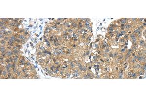 Immunohistochemistry of paraffin-embedded Human breast cancer tissue using TMPRSS11E Polyclonal Antibody at dilution 1:45 (TMPRSS11E anticorps)