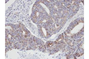 IHC-P Image Immunohistochemical analysis of paraffin-embedded human endo mitral ovarian cancer, using ARPC3, antibody at 1:100 dilution. (ARPC3 anticorps)