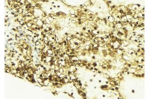 ABIN6269162 at 1/100 staining Human breast cancer tissue by IHC-P. (CREB1 anticorps  (Internal Region))