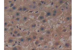 Detection of GCLM in Human Liver cancer Tissue using Polyclonal Antibody to Glutamate Cysteine Ligase, Modifier Subunit (GCLM) (GCLM anticorps  (AA 40-251))