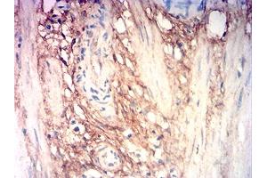 Immunohistochemical analysis of paraffin-embedded stomach cancer tissues using COL3A1 mouse mAb with DAB staining. (COL3A1 anticorps  (AA 24-153))