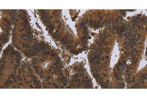 Immunohistochemistry of paraffin-embedded Human colon cancer tissue using PIP Polyclonal Antibody at dilution 1:50 (PIP anticorps)
