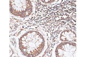 Immunohistochemistry of paraffin-embedded Human colon carcinoma using KIF14 Polyclonal Antibody at dilution of 1:100 (40x lens).