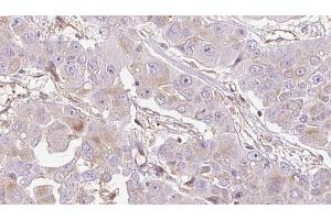 ABIN6272715 at 1/100 staining Human liver cancer tissue by IHC-P.
