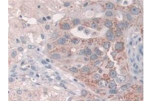 Detection of Grb10 in Human Breast cancer Tissue using Polyclonal Antibody to Growth Factor Receptor Bound Protein 10 (Grb10)