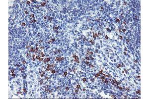 Immunohistochemical staining of paraffin-embedded Human lymphoma tissue using anti-IGJ mouse monoclonal antibody. (IGJ anticorps)