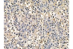 PKM2 Mouse Monoclonal Antibody at 1/100 staining human gastric cancer by IHC-P. (PKM2 anticorps  (Internal Region))