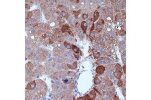 Immunohistochemistry of paraffin-embedded human liver cancer using Cyclin B2 Rabbit mAb (ABIN7266557) at dilution of 1:100 (40x lens). (Cyclin B2 anticorps)