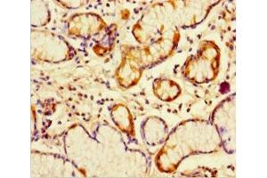 Immunohistochemistry of paraffin-embedded human gastric cancer using ABIN7162782 at dilution of 1:100 (PGLYRP4 anticorps  (AA 18-317))