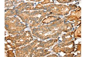 The image on the left is immunohistochemistry of paraffin-embedded Human thyroid cancer tissue using ABIN7192361(SIGLEC14 Antibody) at dilution 1/30, on the right is treated with synthetic peptide. (SIGLEC14 anticorps)