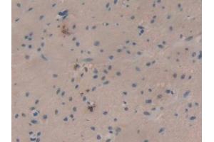 IHC-P analysis of Human Colorectal cancer Tissue, with DAB staining. (SLURP1 anticorps  (AA 1-103))
