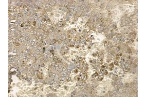 ABIN6256168 and ABIN6267171 at 1/100 staining human melanoma by IHC-P. (RIPK1 anticorps  (pSer166))