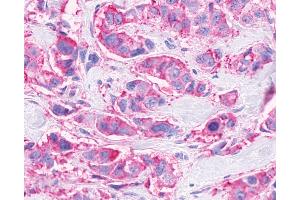 Anti-FFAR3 / GPR41 antibody IHC of human Breast, Carcinoma. (FFAR3 anticorps  (Internal Region))