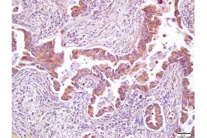 Formalin-fixed and paraffin embedded human lung carcinoma labeled with Anti-AMPK beta 2 Polyclonal Antibody, Unconjugated (ABIN751858) at 1:200 followed by conjugation to the secondary antibody and DAB staining