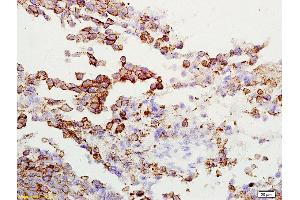 Formalin-fixed and paraffin embedded rat lung carcinoma labeled with Anti-Gamma-Adaptin Polyclonal Antibody, Unconjugated  at 1:200 followed by conjugation to the secondary antibody and DAB staining (gamma 1 Adaptin anticorps  (AA 721-822))
