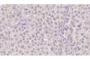 ABIN6276805 at 1/100 staining Human melanoma tissue by IHC-P. (Vitronectin anticorps  (Internal Region))