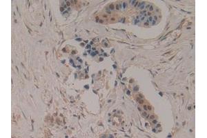 Detection of 0 in Human Breast cancer Tissue using Polyclonal Antibody to Superoxide Dismutase Copper Chaperone