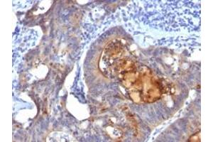 Immunohistochemical staining (Formalin-fixed paraffin-embedded sections) of human colon carcinoma with ECM1 monoclonal antibody, clone ECM1/792 .