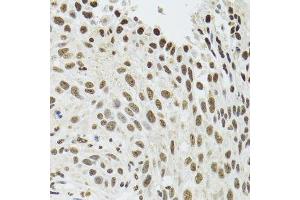 Immunohistochemistry of paraffin-embedded human lung cancer using SFPQ antibody.