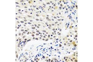 Immunohistochemistry of paraffin-embedded human lung cancer using MYOG antibody (ABIN5974015) at dilution of 1/100 (40x lens). (Myogenin anticorps)
