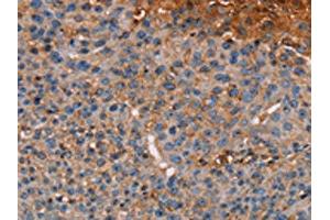 The image on the left is immunohistochemistry of paraffin-embedded Human breast cancer tissue using ABIN7130441(NOC2L Antibody) at dilution 1/20, on the right is treated with fusion protein.