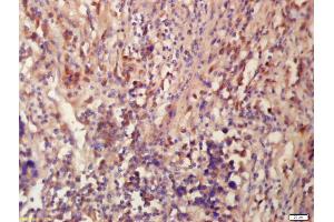 Formalin-fixed and paraffin embedded human lung carcinoma labeled with Anti-Tubulin-Beta Polyclonal Antibody, Unconjugated (ABIN672231) at 1:200 followed by conjugation to the secondary antibody and DAB staining