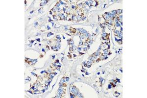 Immunohistochemistry of paraffin-embedded human breast cancer using KMT2E antibody (ABIN6131786, ABIN6142983, ABIN6142984 and ABIN6221745) at dilution of 1:200 (40x lens).