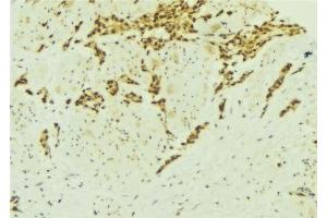 ABIN6277137 at 1/100 staining Human breast cancer tissue by IHC-P. (ATF2 anticorps  (N-Term))