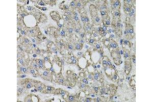 Immunohistochemistry of paraffin-embedded Human liver damage using GFPT1 Polyclonal Antibody at dilution of 1:100 (40x lens). (GFPT1 anticorps)