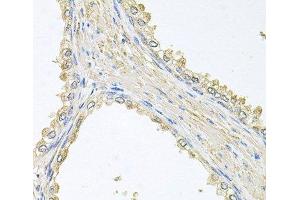 Immunohistochemistry of paraffin-embedded Human prostate using PMM2 Polyclonal Antibody at dilution of 1:100 (40x lens). (PMM2 anticorps)