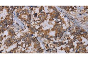 Immunohistochemistry of paraffin-embedded Human liver cancer using REG3G Polyclonal Antibody at dilution of 1:40