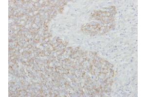 IHC-P Image Immunohistochemical analysis of paraffin-embedded human breast cancer, using NARS, antibody at 1:250 dilution. (NARS anticorps)
