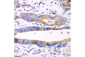 Immunohistochemistry of paraffin-embedded human gastric cancer using CHIA antibody (ABIN5971776) at dilution of 1/100 (40x lens). (CHIA anticorps)