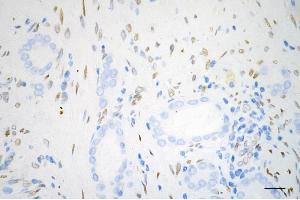 Immunohistochemistry was performed on paraffin-embedded human prostatic adenocarcinoma using fibroblast growth factor 2 antibody (ABIN7798604), 1:200).