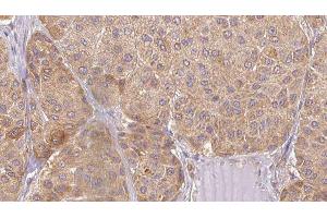 ABIN6277481 at 1/100 staining Human Melanoma tissue by IHC-P. (Neurotrophin 4 anticorps  (Internal Region))