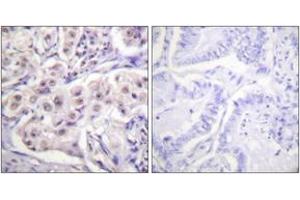 Immunohistochemistry analysis of paraffin-embedded human lung carcinoma tissue, using hnRPD (Ab-83) Antibody. (HNRNPD/AUF1 anticorps  (AA 49-98))