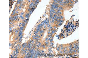 Immunohistochemistry of Human thyroid cancer using MUC6 Polyclonal Antibody at dilution of 1:40 (MUC6 anticorps)