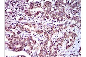 Immunohistochemical analysis of paraffin-embedded cervical cancer tissues using ABCG5 mouse mAb with DAB staining.