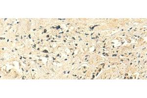 Immunohistochemistry of paraffin-embedded Human prost at e cancer tissue using MTHFS Polyclonal Antibody at dilution of 1:50(x200) (MTHFS anticorps)
