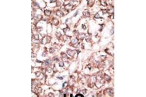Formalin-fixed and paraffin-embedded human cancer tissue reacted with the primary antibody, which was peroxidase-conjugated to the secondary antibody, followed by DAB staining.
