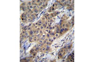 TGFB1 Antibody immunohistochemistry analysis in formalin fixed and paraffin embedded human breast carcinoma followed by peroxidase conjugation of the secondary antibody and DAB staining.