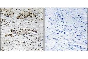 Immunohistochemistry analysis of paraffin-embedded human breast carcinoma, using Estrogen Receptor-alpha (Phospho-Ser102) Antibody. (Estrogen Receptor alpha anticorps  (pSer102))