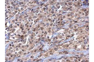 IHC-P Image Importin 7 antibody [C3], C-term detects Importin 7 protein at cytoplasm and nucleus on human ovarian carcinoma by immunohistochemical analysis. (IPO7 anticorps  (C-Term))