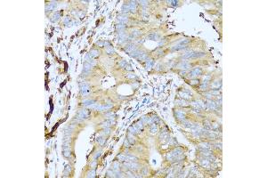 Immunohistochemistry of paraffin-embedded human colon carcinoma using CSH1 antibody (ABIN5971023) at dilution of 1/100 (40x lens).