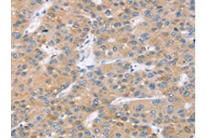 The image on the left is immunohistochemistry of paraffin-embedded Human liver cancer tissue using ABIN7131090(SLC27A2 Antibody) at dilution 1/20, on the right is treated with fusion protein.