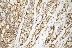 Immunohistochemistry was performed on paraffin-embedded human prostatic adenocarcinoma using arg2 antibody (ABIN7797644), 1:200). (Recombinant ARG2 anticorps)