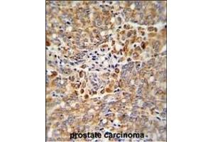 Formalin-fixed and paraffin-embedded human prostate carcinoma reacted with ALKBH3 Antibody (C-term), which was peroxidase-conjugated to the secondary antibody, followed by DAB staining. (ALKBH3 anticorps  (C-Term))